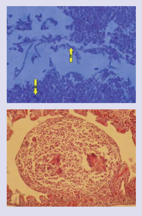 aspergillosis